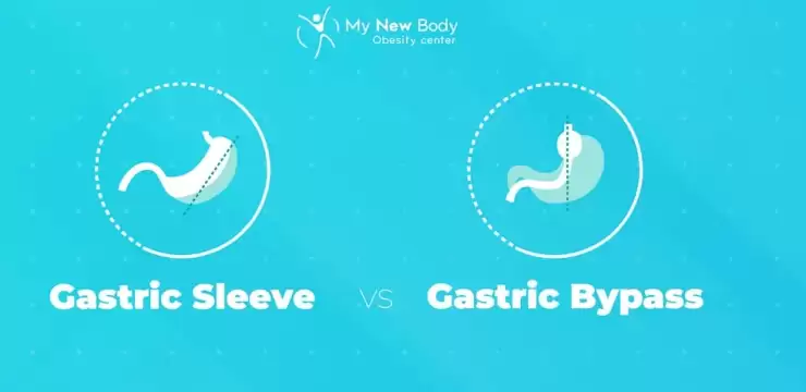 Gastric Sleeve Vs Gastric Bypass