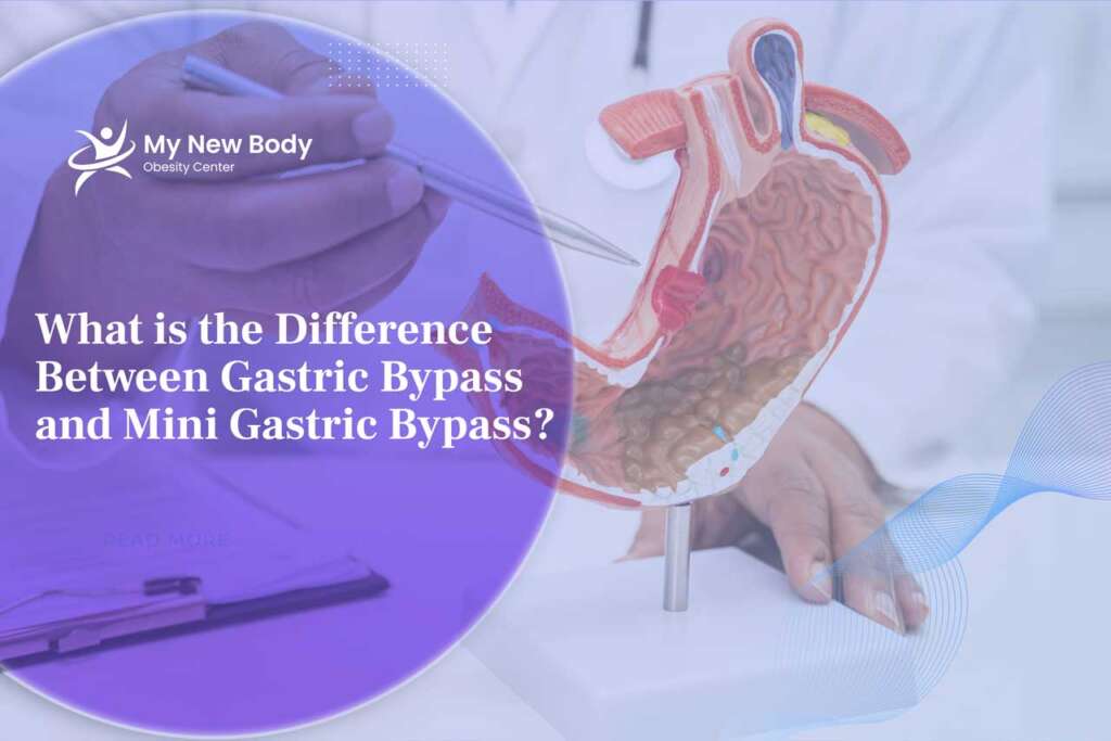 What is the difference between Mini Gastric Bypass and Gastric Bypass?